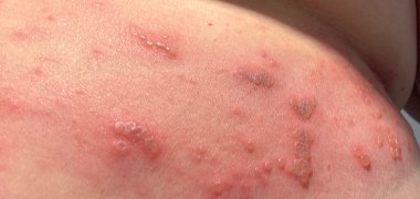 Ein Symptom der Gürtelrose ist ein geröteter Ausschlag mit Bläschen auf der Haut.