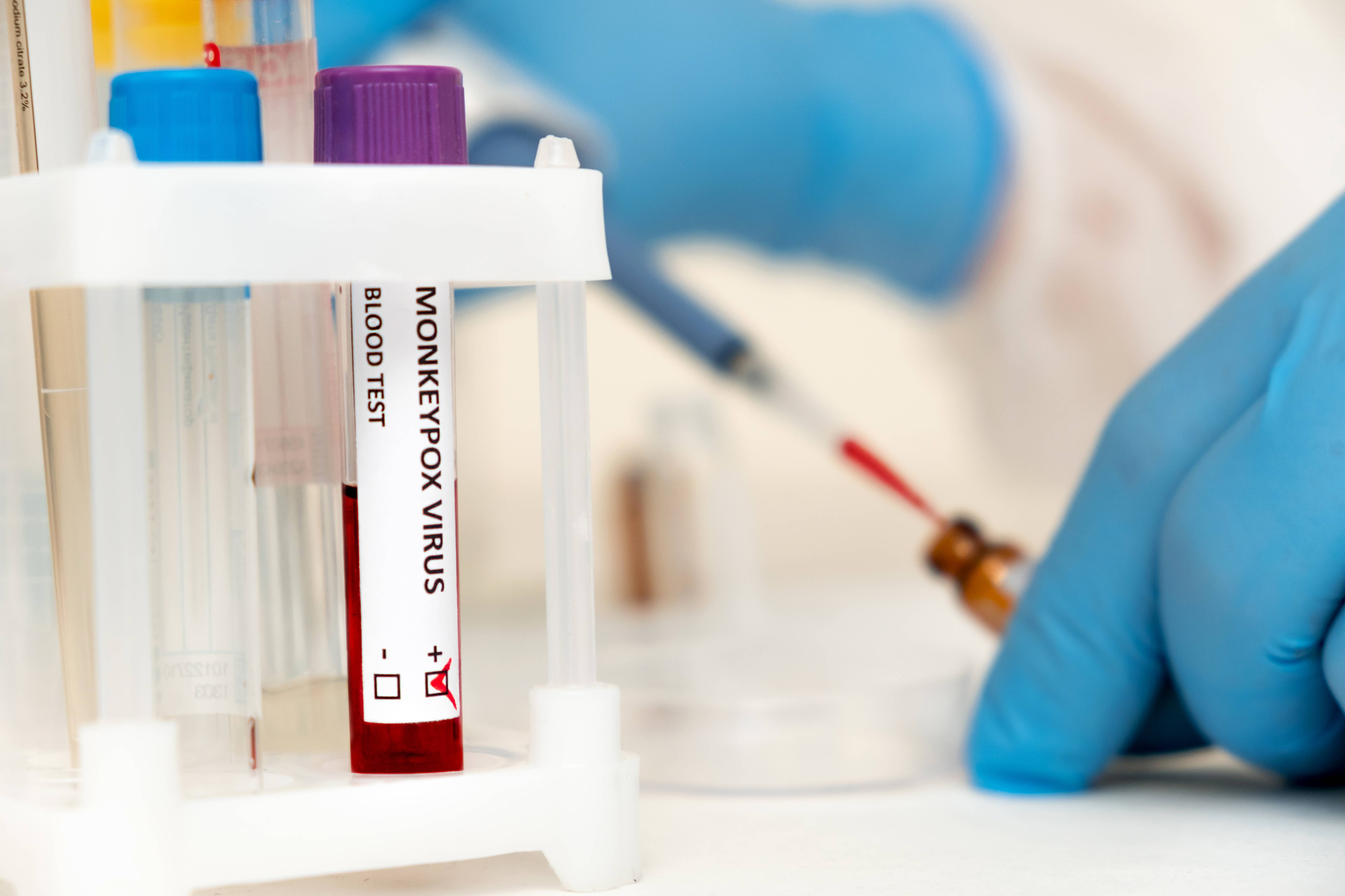 Eine Teströhre mit Blut, das laut Beschriftung mit dem Affenpocken-Virus infiziert ist.