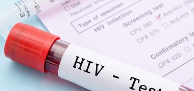 Blutprobe mit HIV Aufkleber